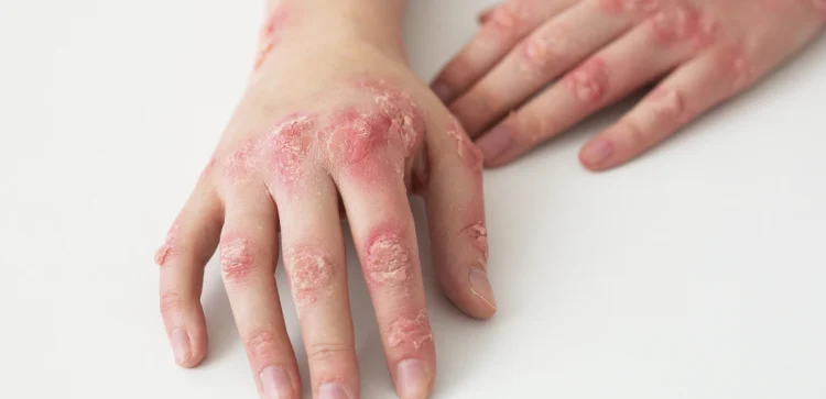 alergólogo pediatra Tlanepantla en CDMX y Edo Mex