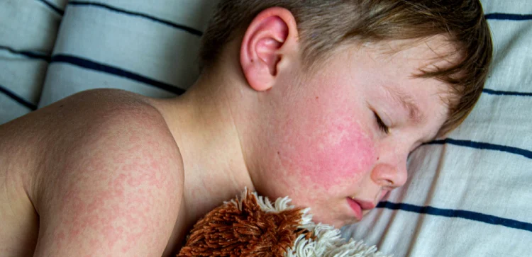 especialista en alergias cerca de metro coyoacan en CDMX y Edo Mex