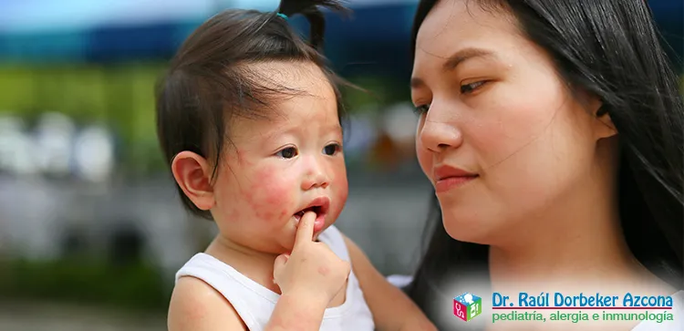 Asma y alergias en dermatitis atópica en CDMX y Edo Mex