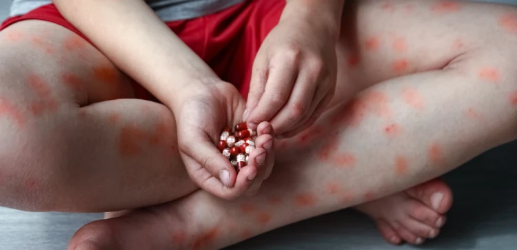 Asma y Alergias en Miguel Hidalgo en CDMX y Edo Mex