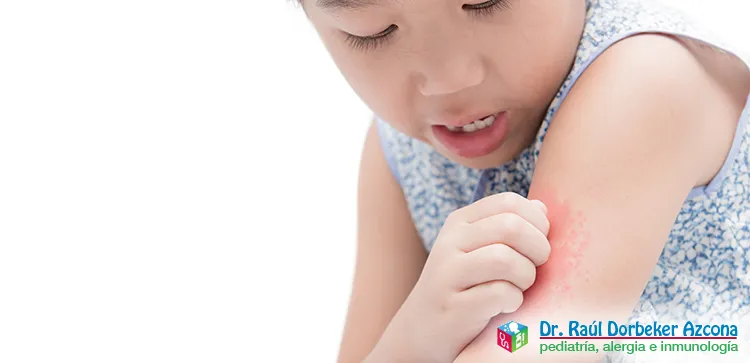 Asma y alergias en pruebas cutáneas en CDMX y Edo Mex