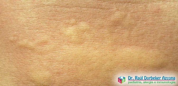 Asma y alergias en urticaria en CDMX y Edo Mex