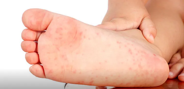 urticaria angioedema